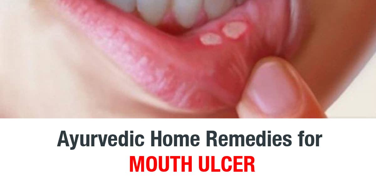10 Easy Ayurvedic Home Remedies for Mouth Ulcer