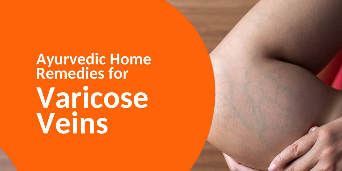 simple Home Remedies for Varicose Veins
