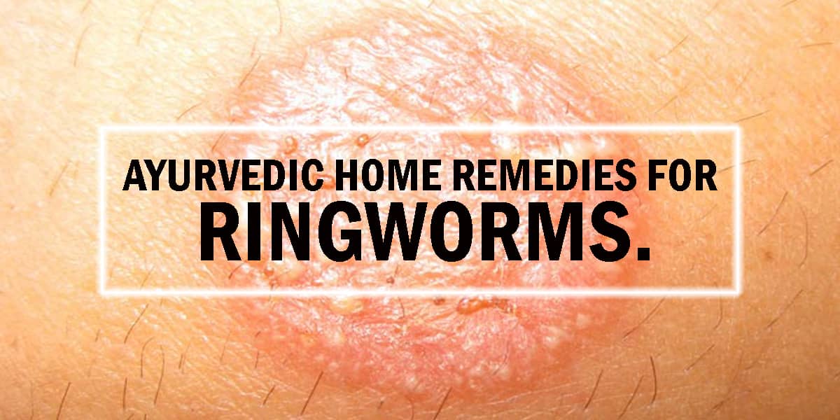 Ayurvedic Home Remedies for Ringworms