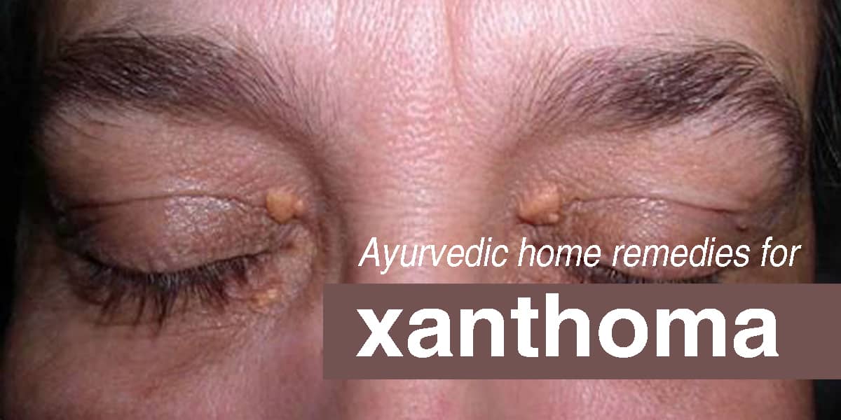 Ayurvedic Home Remedies for Xanthalesma 