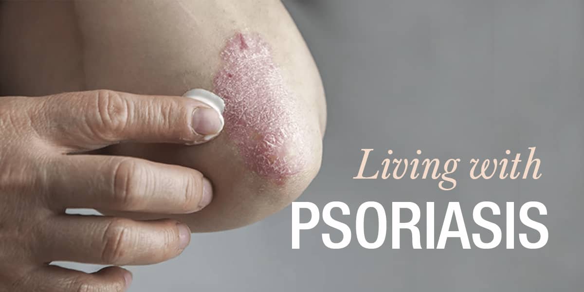 AYURVEDIC TREATMENT FOR PSORIASIS