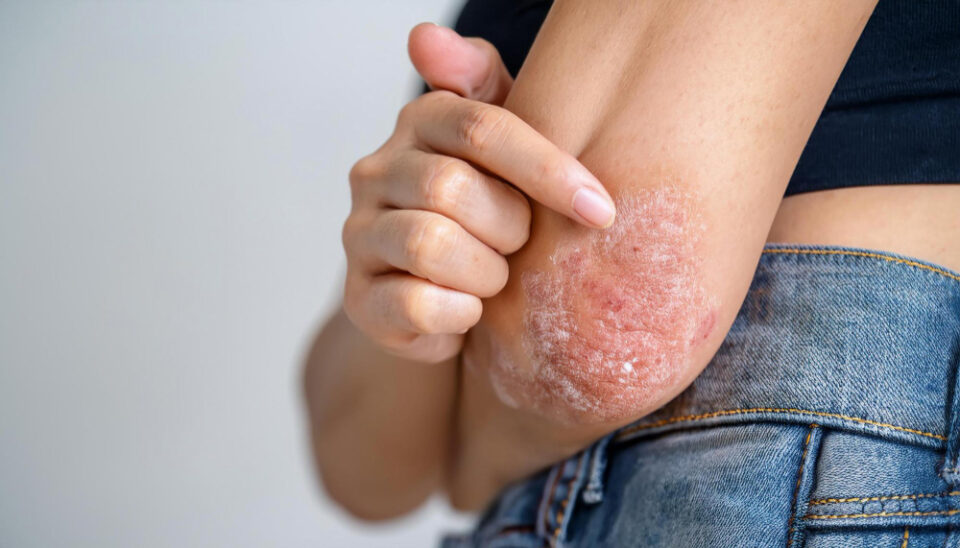 Can Stress Trigger Your Psoriasis Flares?